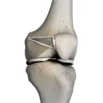 Inestabilidad rotuliana