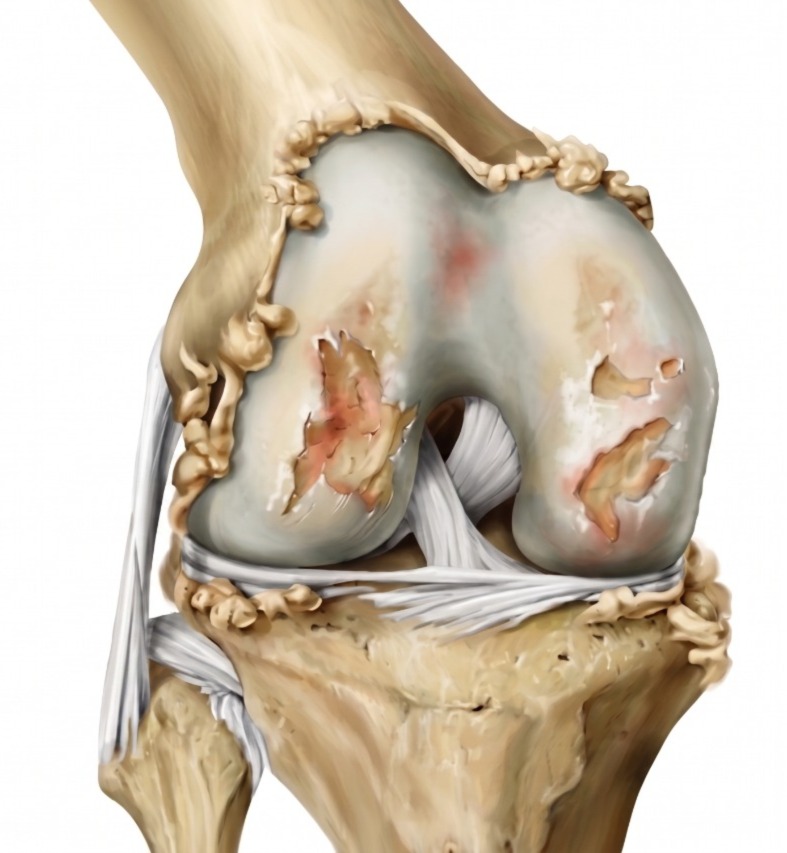 Artrosis de rodilla
