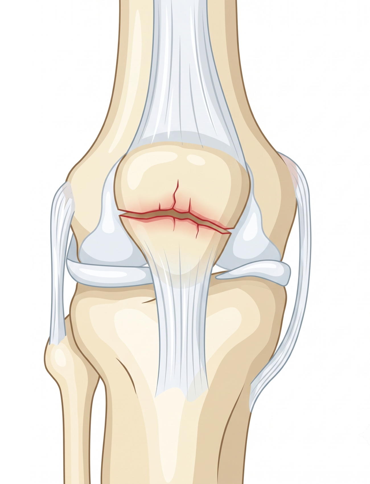 Fractura de rótula — ilustración