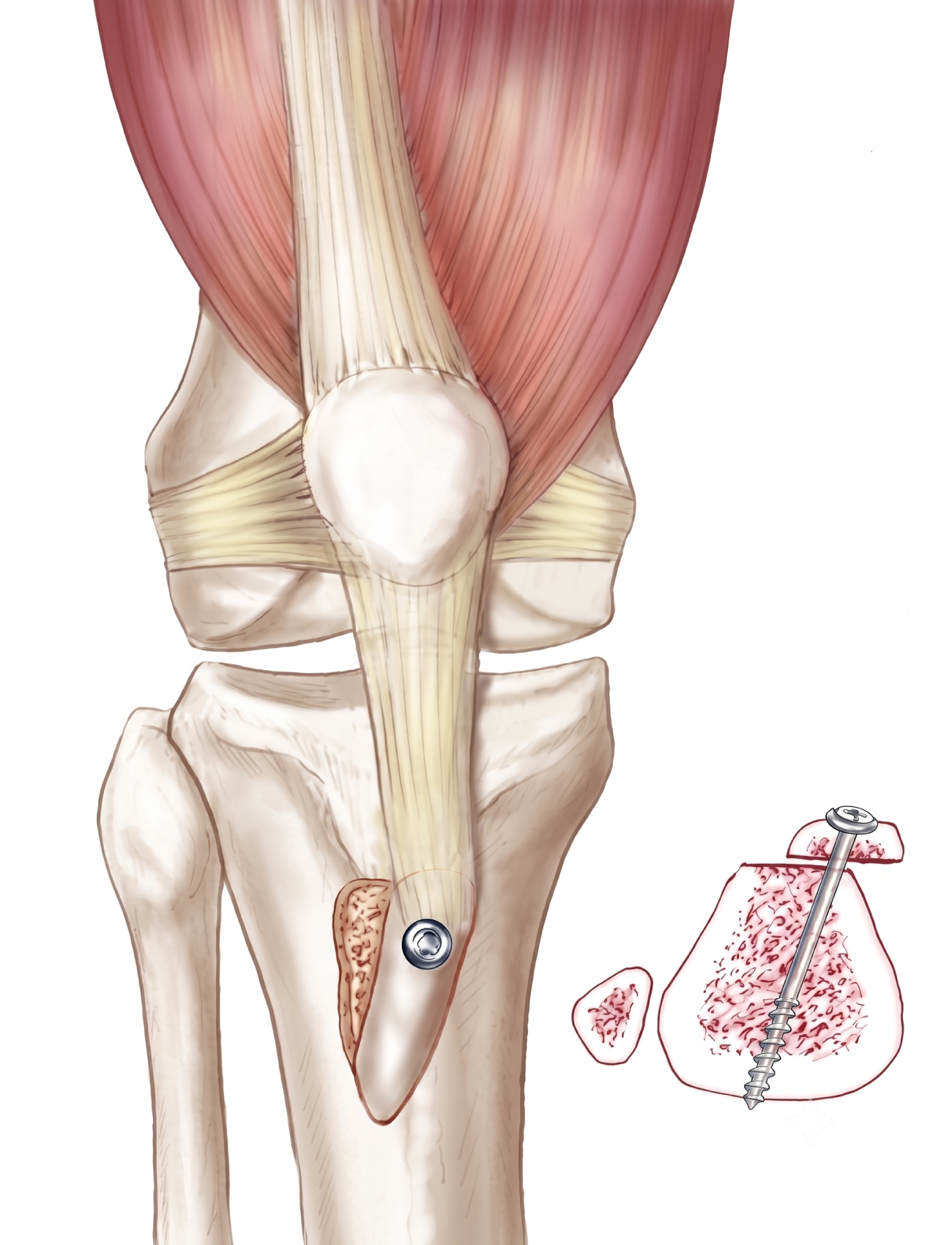 Inestabilidad rotuliana