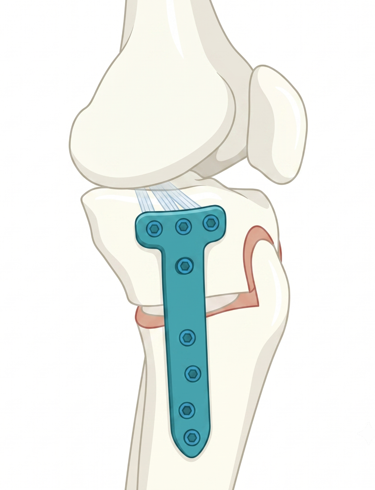 Osteotomía de rodilla — ilustración