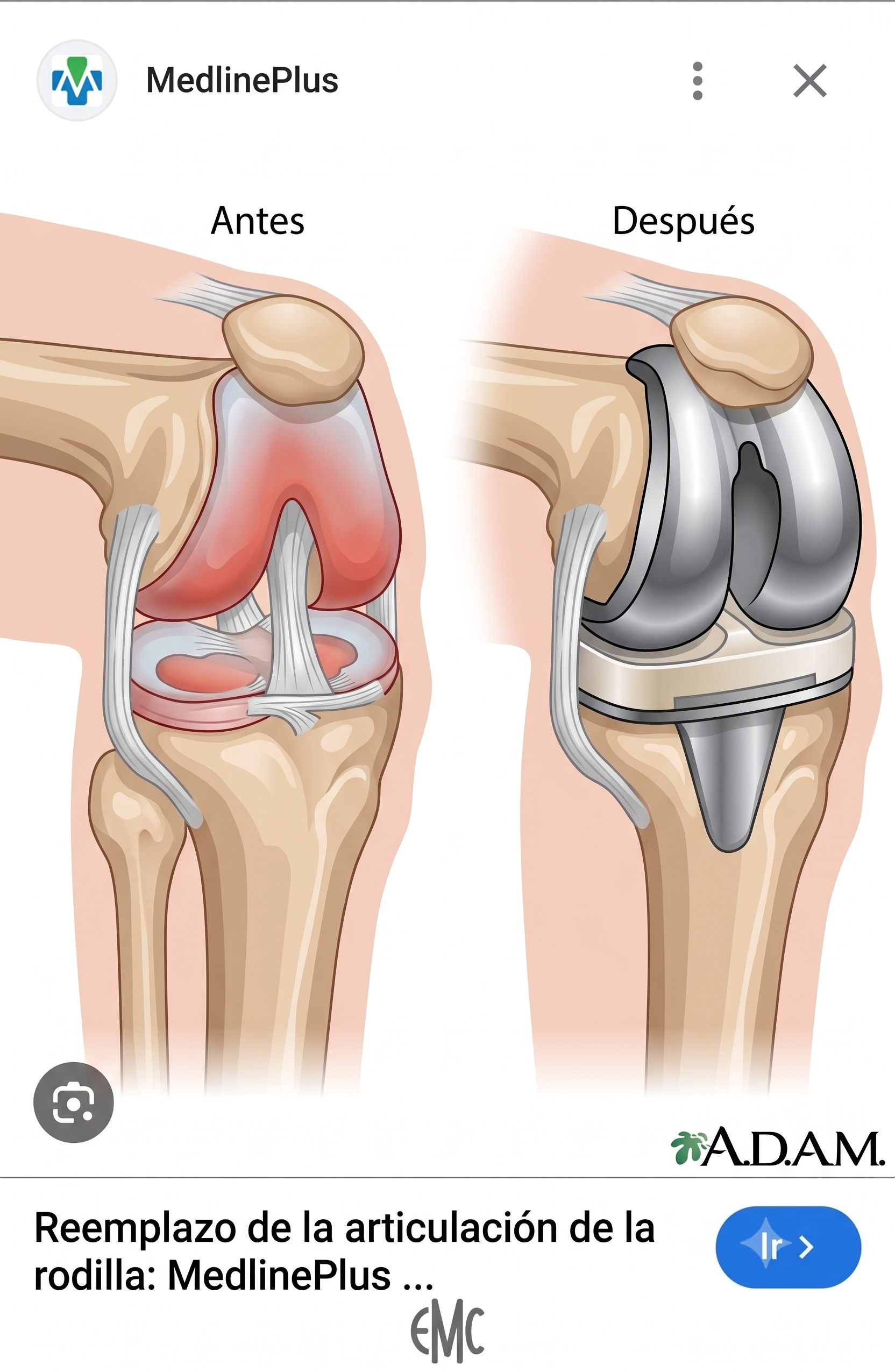 Prótesis de rodilla