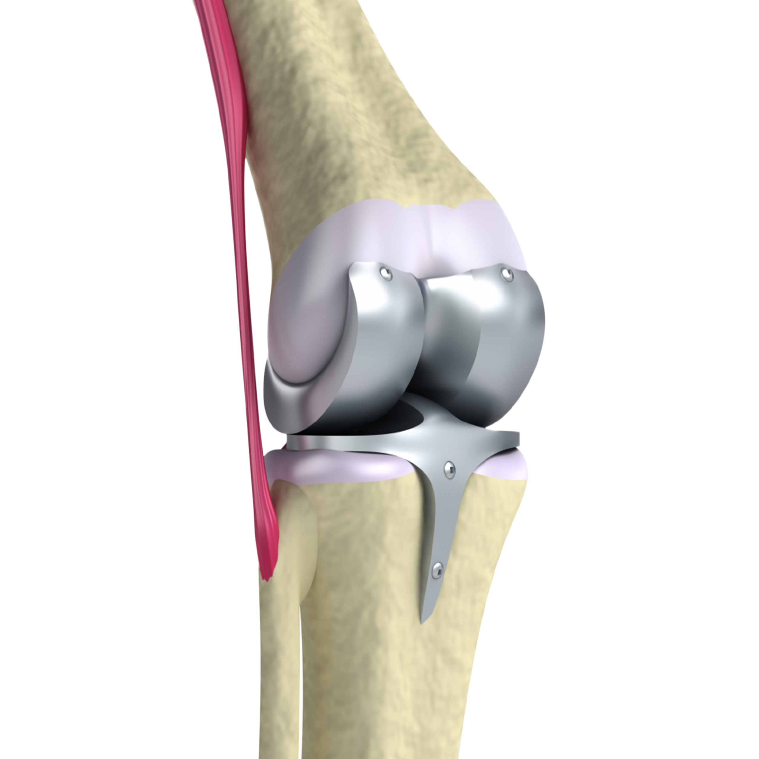 Prótesis total de rodilla
