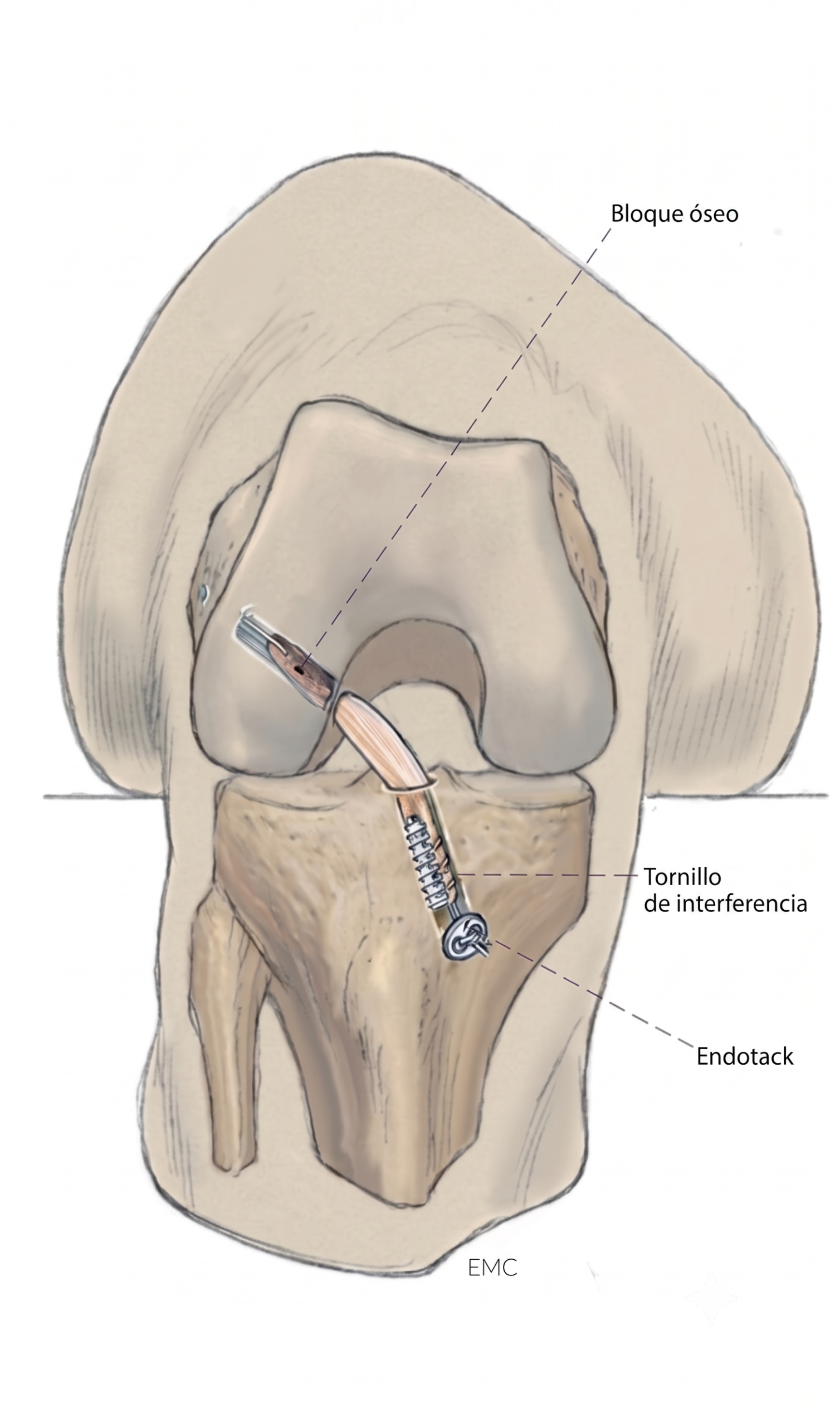 Reconstrucción de ligamentos de rodilla